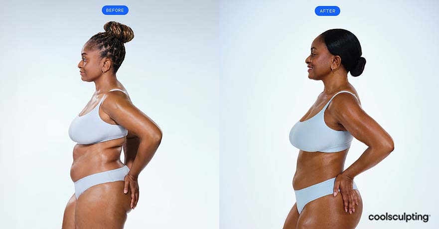 CoolSculpting-BA