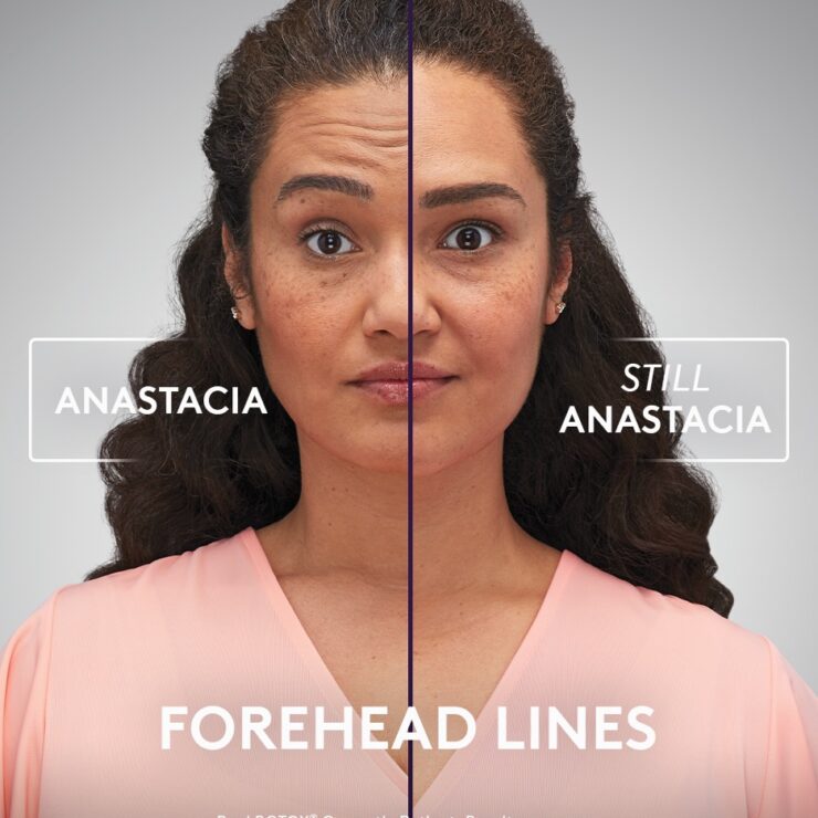 A split view of a woman named Anastacia before and after Botox treatment which smoothed her forehead lines