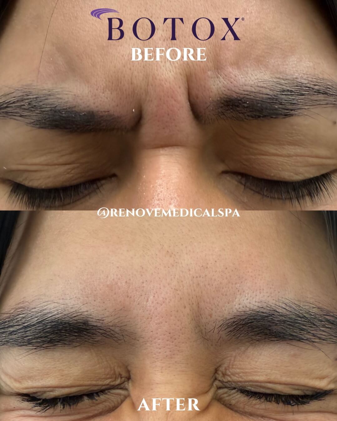 Before and after of forehead wrinkles with Juvederm Botox