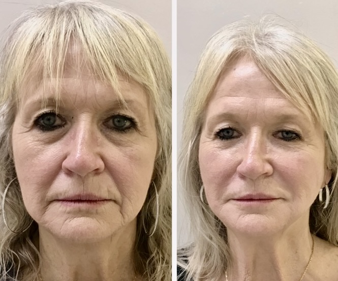 Before and after images of blonde woman with PDO threads lift