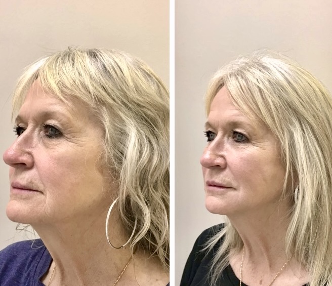 Thread lift before and after comparison of a blonde woman