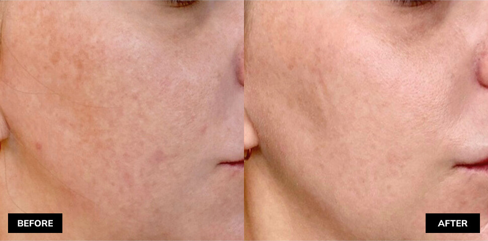 Before and after picture of face reatment using microneedling