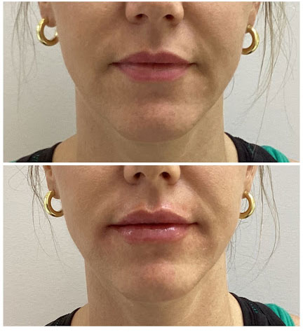 Before and after pictures following treatment with injectables