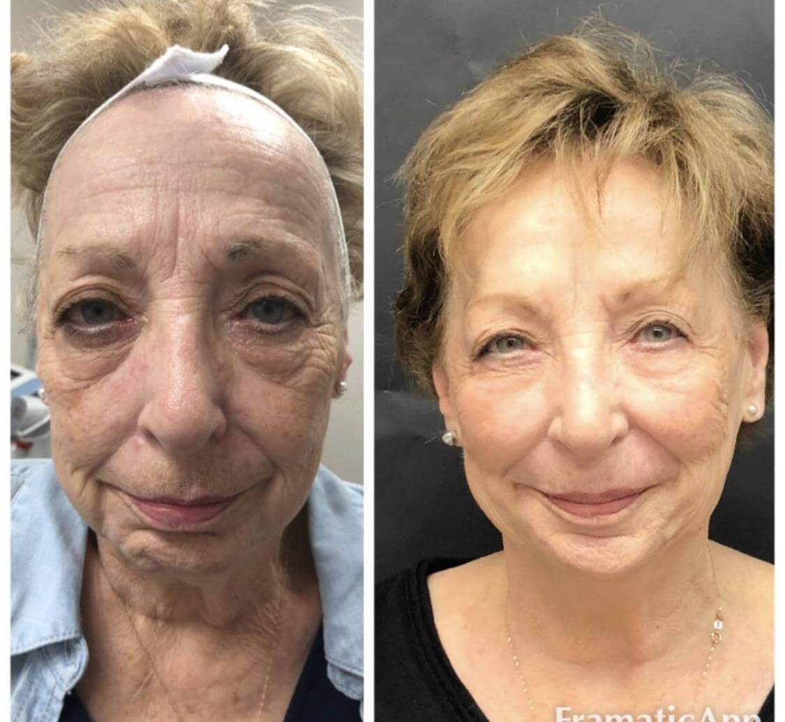 woman before and after threading facelift