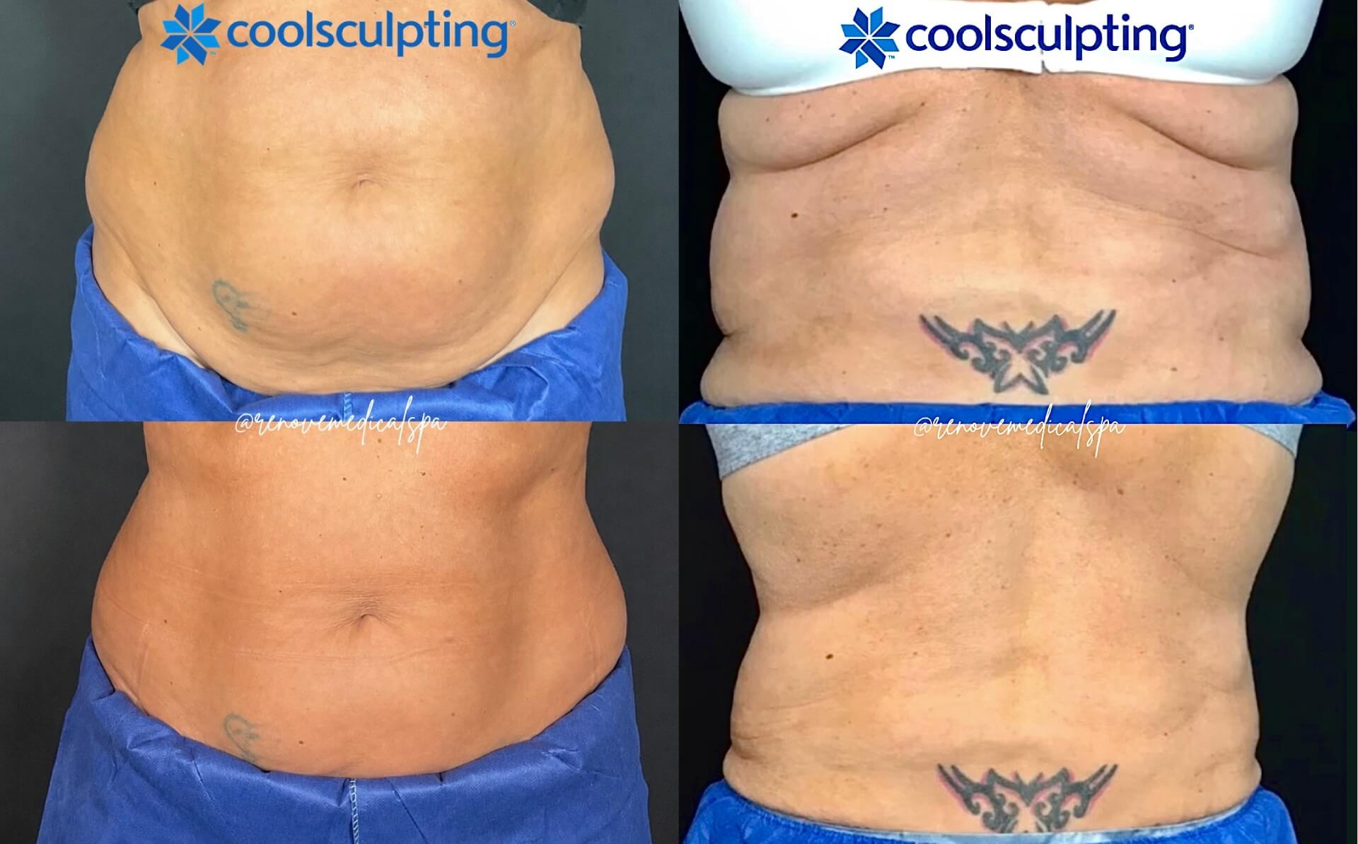 Coolsculpting Before After