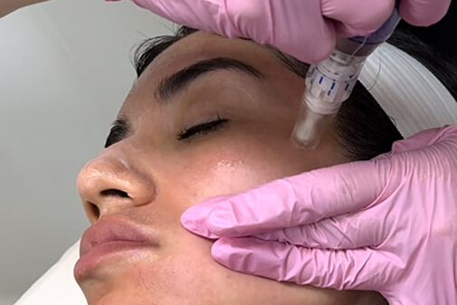 Women getting microneedling treatment