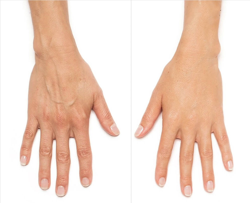 Hands before and after receiving Radiesse injectables treatment