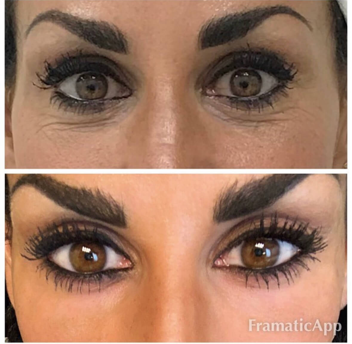 A woman’s eyes before and after receiving Juvéderm Volbella injectables treatment.
