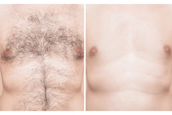 before and after chest laser hair removal