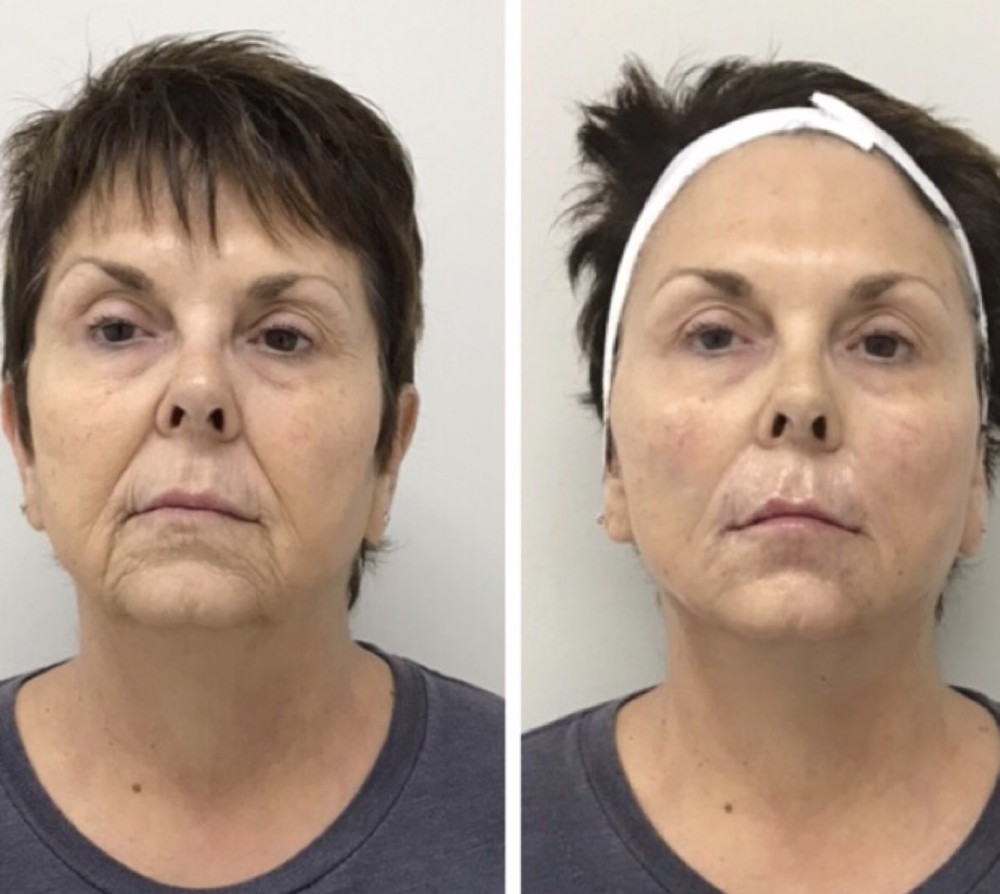 A woman’s face before and after receiving Botox and injectable treatments in Houston.