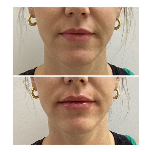 A woman’s lips before and after receiving lip filler injections.