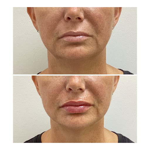 Before and after pictures of a woman who received lip filler injections.