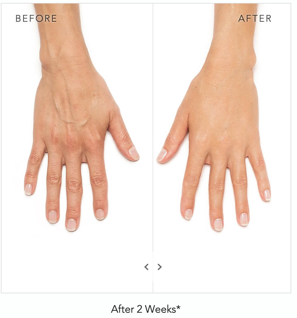 Hands before and after receiving Radiesse injectables treatment