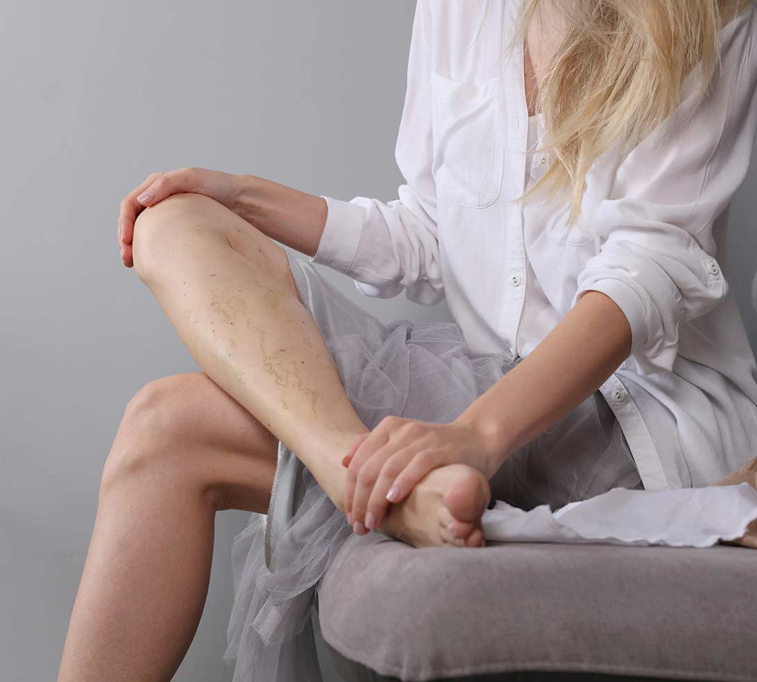 A woman examines varicose veins on her leg