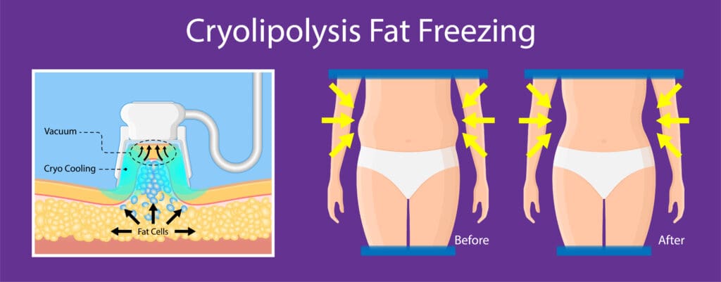 An infographic that briefly illustrates how cryolipolysis works on fat