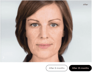 A brunette woman’s face 25 months after receiving SculptraⓇ treatment 