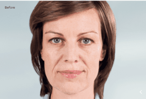 A brunette woman’s face before receiving SculptraⓇ treatment