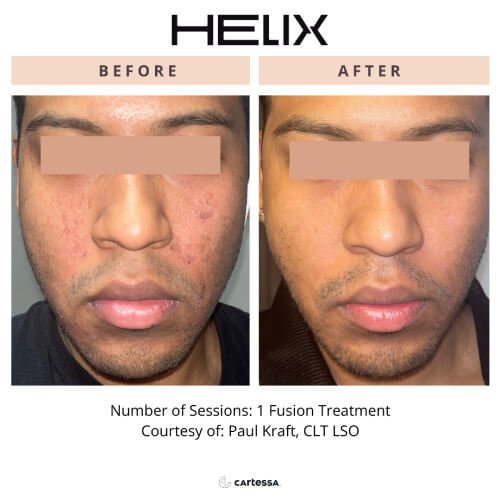 Before and after photos of a person’s acne scars after undergoing Fusion treatment