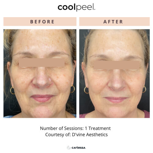 Two images of a woman’s face—one before and one after one CoolPeel treatment