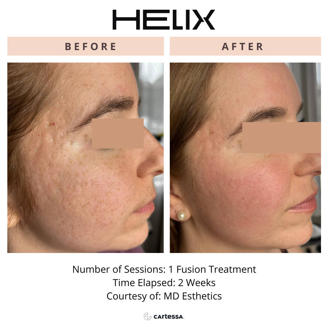 Before and after images of a woman’s face to illustrate the results of one HELIX Fusion laser skin resurfacing procedure