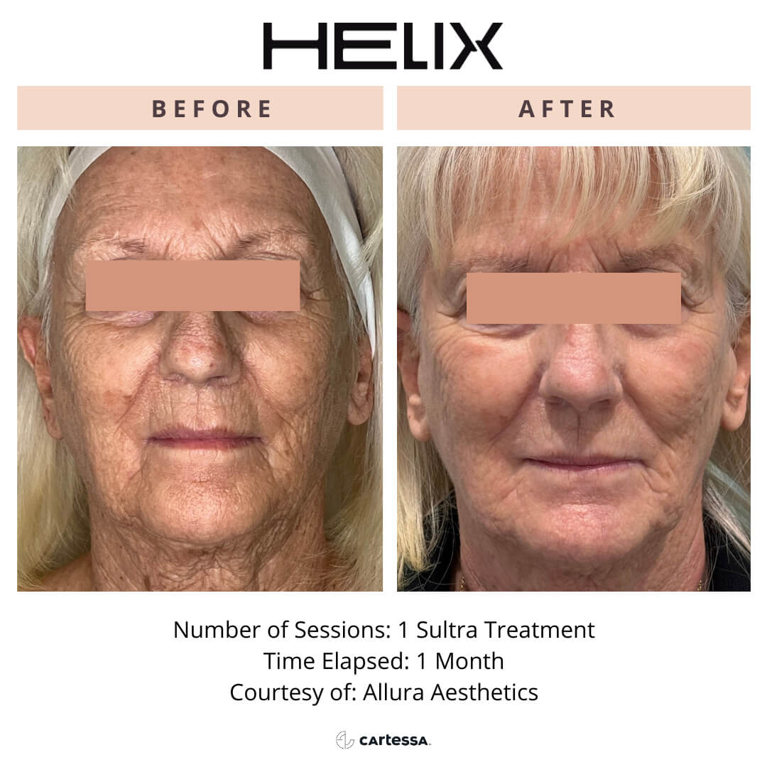 Side-by-side images of a woman before and after one Sultra non-ablative laser skin resurfacing procedure