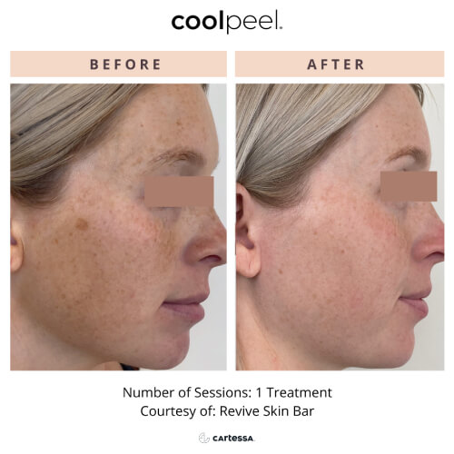 Two images of a woman’s face to illustrate texture and tone before and after one CoolPeel treatment