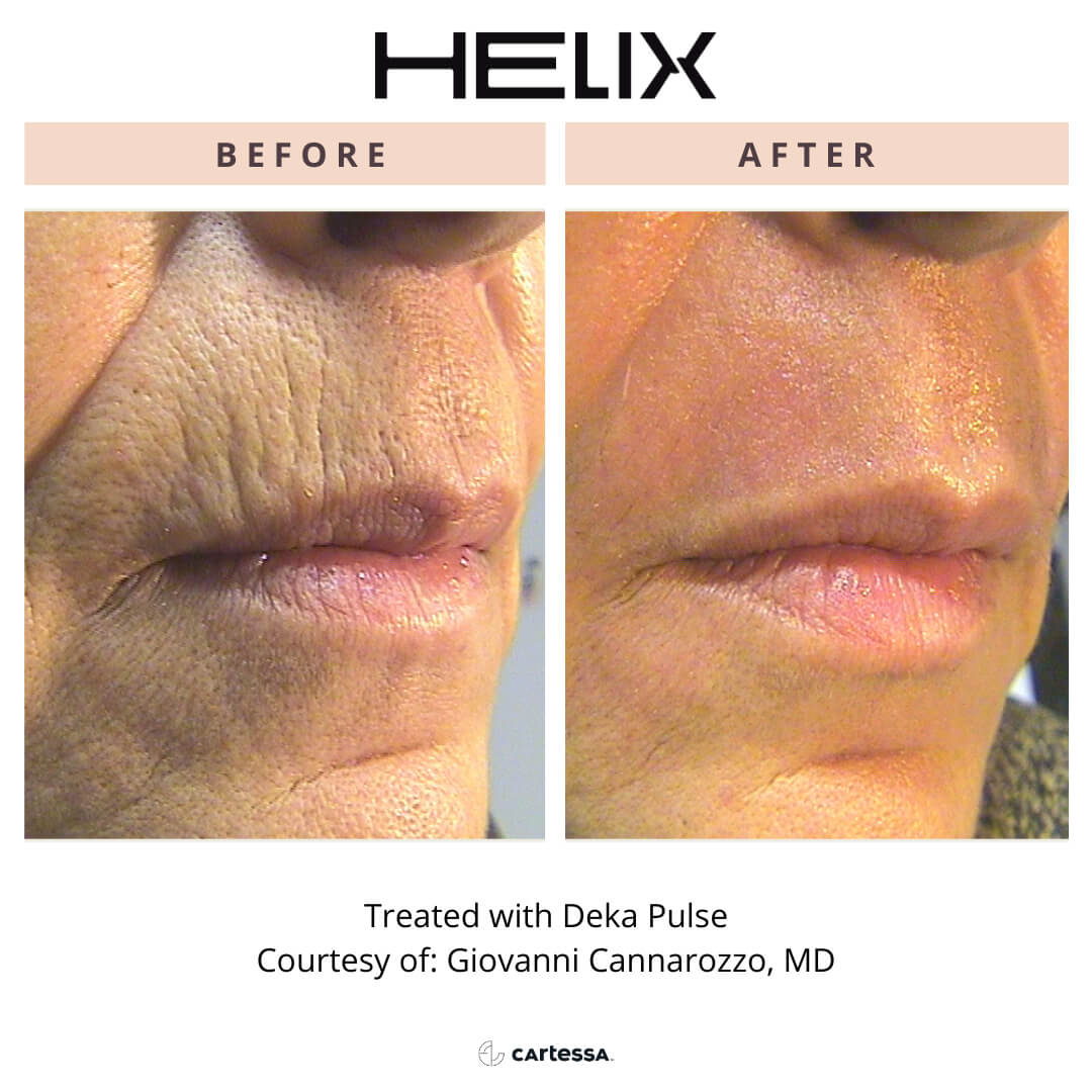 Side-by-side images of a woman’s mouth area which illustrate fewer fine lines and wrinkles after a HELIX laser DEKA Pulse treatment