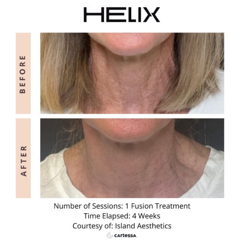 Before and after images of a person’s neck four weeks after Fusion treatment