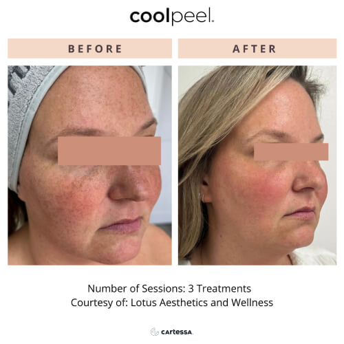 Side-by-side images of a woman’s face illustrating the results of three CoolPeel treatments