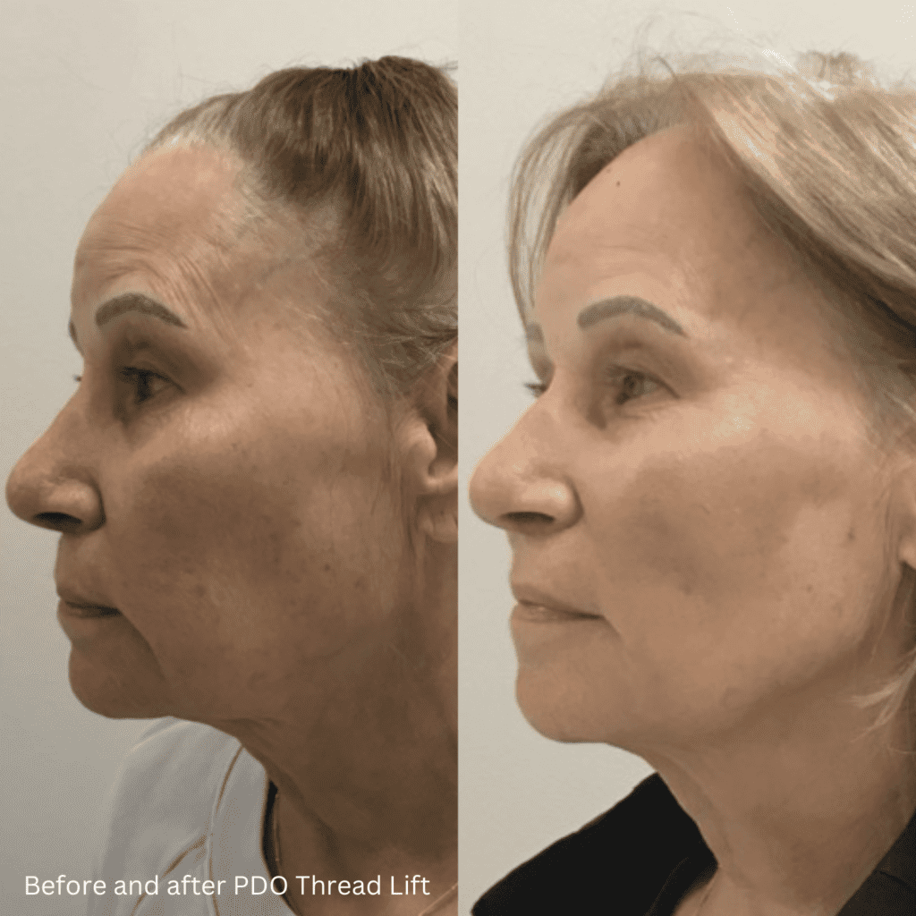 Before and after views of a woman who received PDO Thread Lift treatment