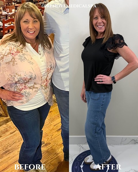 A side-by-side comparison of a woman before and after Semaglutide treatment, noticeably thinner