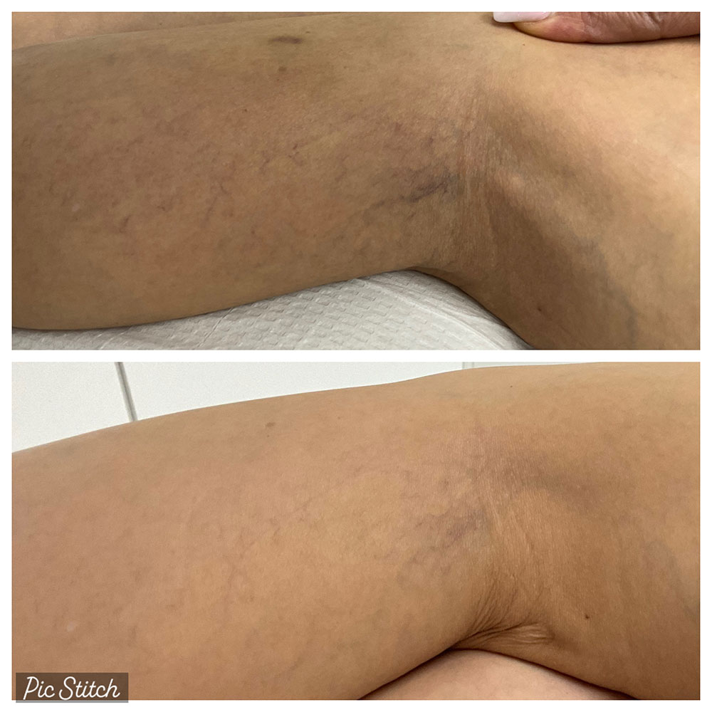 Before and after images of sclerotherapy treatment