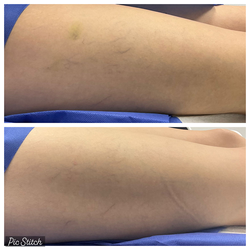 Before and after images of sclerotherapy treatment