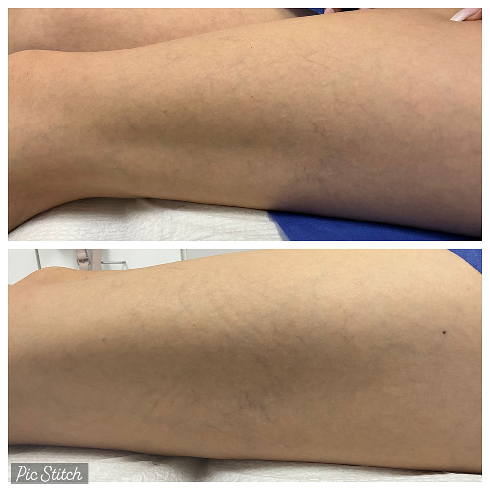 Before and after images of sclerotherapy treatment