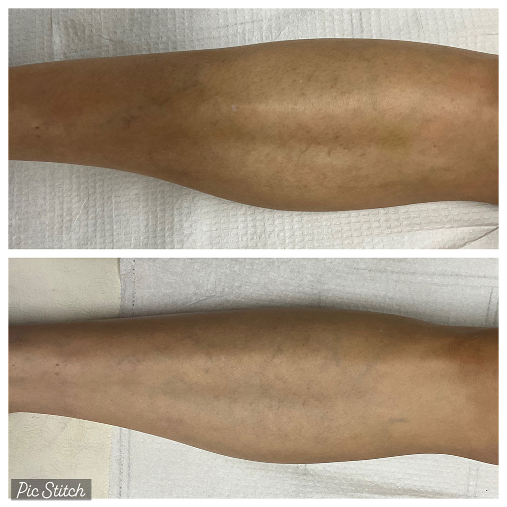Before and after images of sclerotherapy treatment