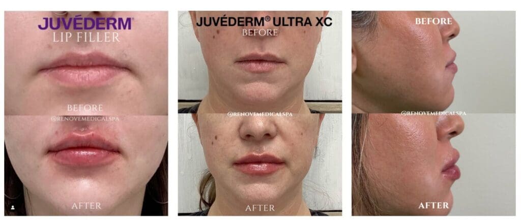 Before-and-after images of Juvéderm treatments
