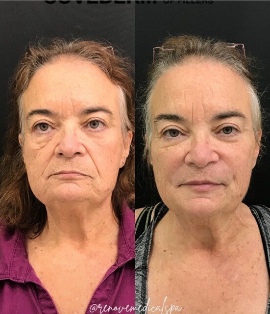 Before-and-after picture of a woman